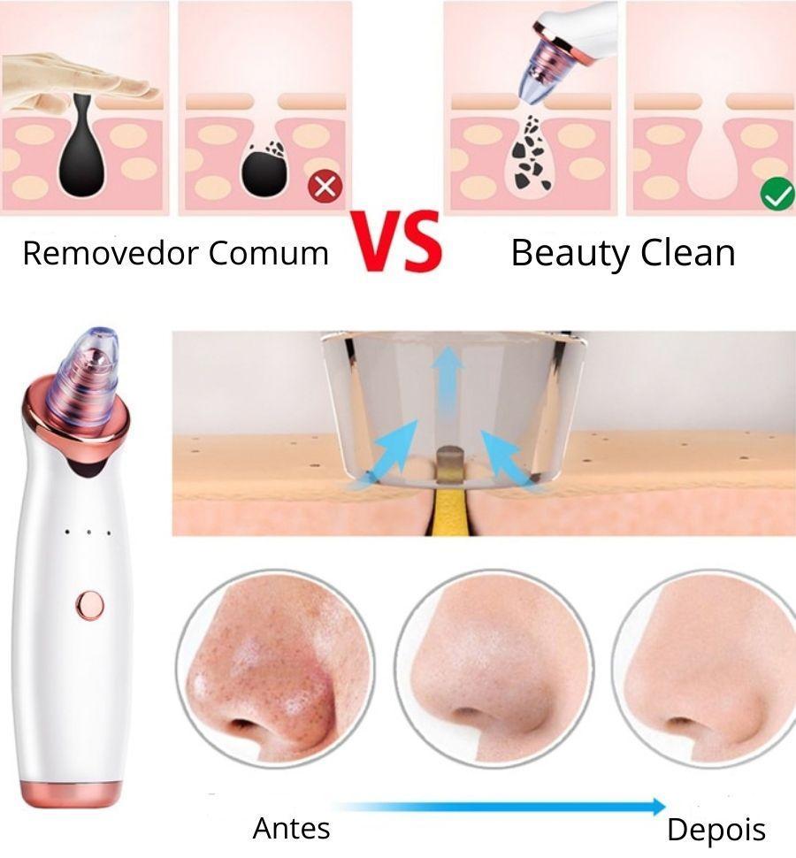 Beauty Clean - Removedor de Cravos e Espinhas - Loja Oficial | XploudShop