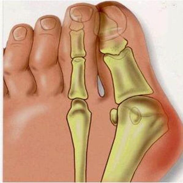 Hallux Redux - Adeus Joanete - 2 peças (1 par) - Loja Oficial | XploudShop